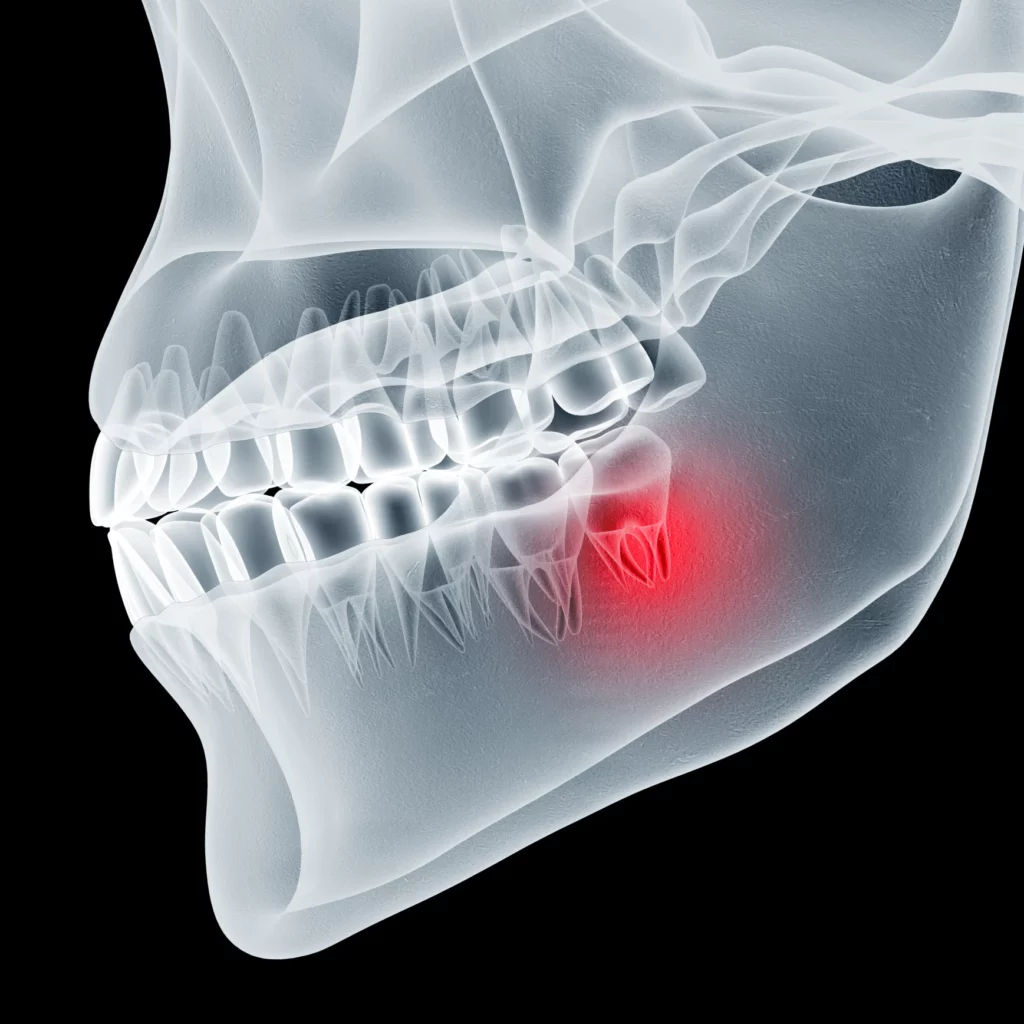 wisdom teeth removal in Northwest Florida